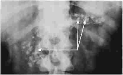 Оглядова рентгенограма органів черевної порожнини при хронічному кальціфіцірующем панкреатиті