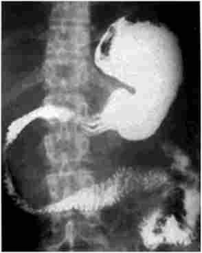Деформація контуру вихідного відділу шлунка і розворот дванадцятипалої кишки при кісті головки підшлункової залози