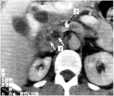 Комп'ютерна томографія при хронічному кальціфіцірующем панкреатиті. На знімку видно кісти головки підшлункової залози (У), розширений вірсунгов проток і кальцинат в його просвіті (2)