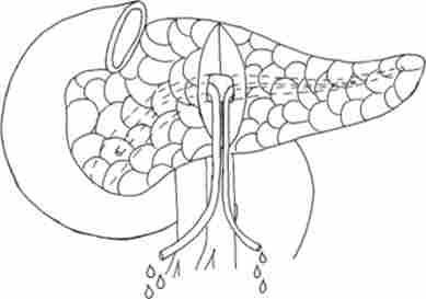 Зовнішнє дренування головного панкреатичного протоку після поперечного розтину підшлункової залози в області тіла (до задньої стінки головного панкреатичного протоку)