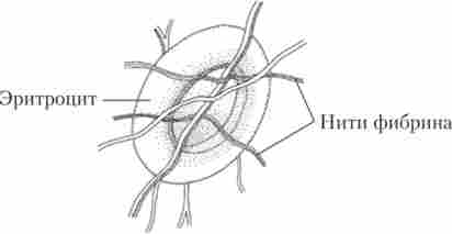 Еритроцит, захоплений нитками фібрину при утворенні червоного тромбу (малюнок на основі електронно-мікроскопічної фотографії)