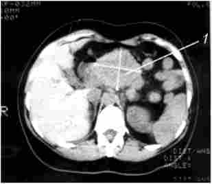 Комп'ютерна томографія. Рак тіла підшлункової залози