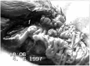 Макропрепарат після панкреатодуоденальной резекції, виконаної тієї ж хворий, знімок якої показаний на рис. 21.8