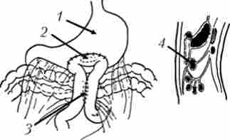 Передній впередіободочний гастроентероанастомоз з міжкишкові соустя по Брауну
