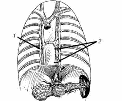 Схема торакоскопічної лівосторонньої спланхнікектоміі з видаленням великого чревного нерва на рівні ThX - ТІХI