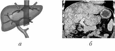 Надпечінкова форма портальної гіпертензії (мозаїчне накопичення контрастного препарату в збільшеної печінки при прохідною ворітної вени і відсутності візуалізації печінкових вен)