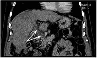 Змішана форма портальної гіпертензії. Комп'ютерно-томографична ангіограма (тромбоз ворітної вени на тлі цирозу печінки - вказано стрілкою)