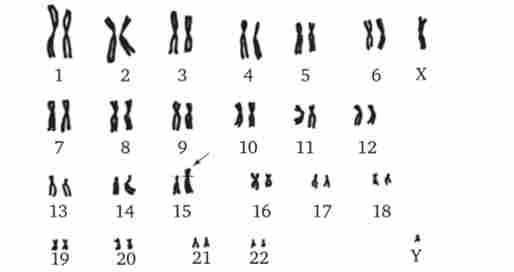 Каріотип при Транслокаційний синдромі Дауна (одна 21-я хромосома приєднана до 15-й хромосомі - зазначено стрілкою)