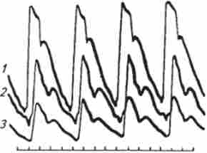Сфігмограми сонної (7), променевої (2) і палацовий (Е) артерій, записані синхронно