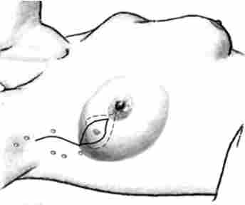 Схема одного з варіантів органозберігаючих операцій (пунктиром показані кордону висічення тканини молочної залози