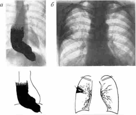 Рентгенологічні симптоми кардіоспазм