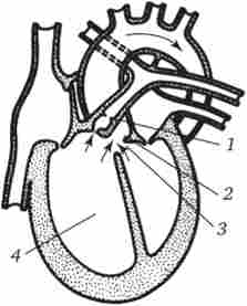 Фронтальний зріз серця з тетрадой Фалло
