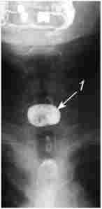 Рентгенограма стравоходу при дивертикулі Ценкера