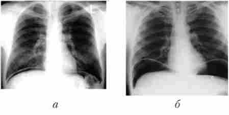 Оглядова рентгенографія живота хворого перфоративного виразкою (положення стоячи)