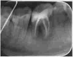 Радіовізіограмма зуба 4.6. Контрольний огляд через 6 МСС