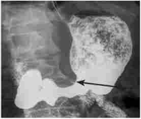 Рентгенологічна картина пухлинного процесу при виразці шлунка