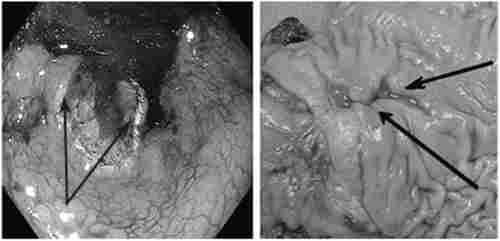 Ендоскопічна картина малігнізованих виразок шлунка