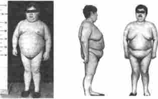 Переродження підшкірної жирової клітковини