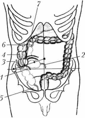 Схема варіантів анатомічного розташування червоподібного відростка